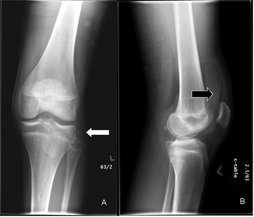 A, anteroposterior radiograph demonstrates the Segond f | Open-i