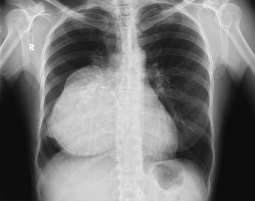 chest-x-ray-clearly-defined-homogenous-opacity-with-pa-open-i