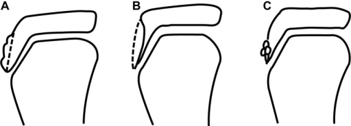 Osgood Schlatter Disease X Ray Findings