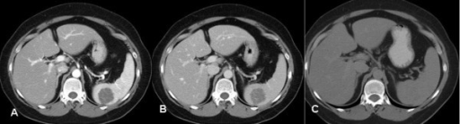 Ct Scan After Oral And Iv Contrast In The Arterial Phas