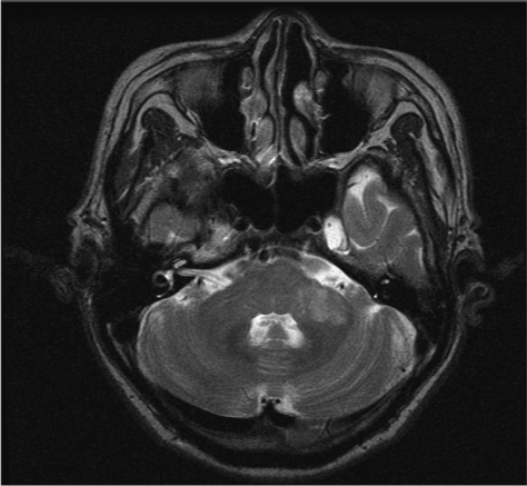 MRI finding in a patient with AICA artery territory inf | Open-i