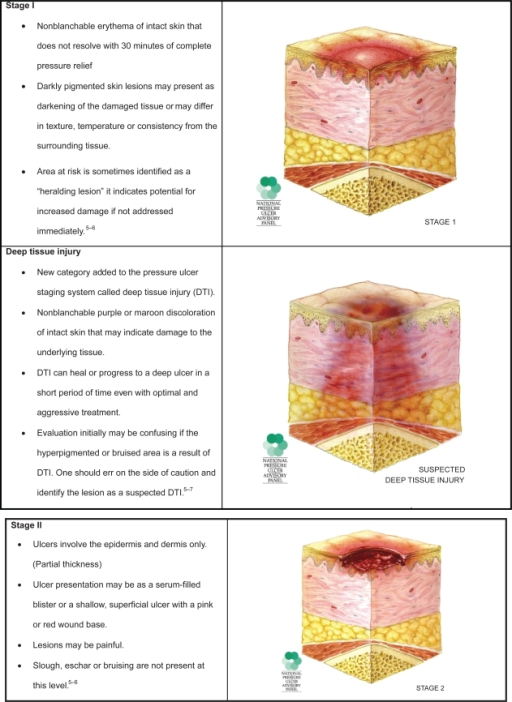 Chart Pressure Ulcer Staging Guide