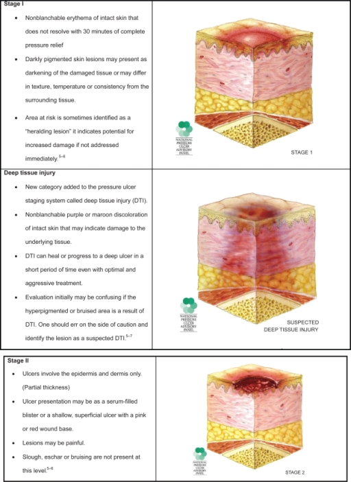 Pressure ulcer staging. Images are reused with permissi | Open-i