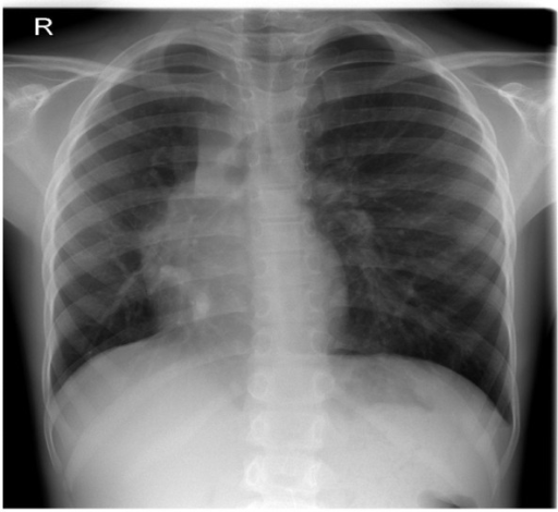 Preoperative Chest X-ray showed a dextroposition and me | Open-i