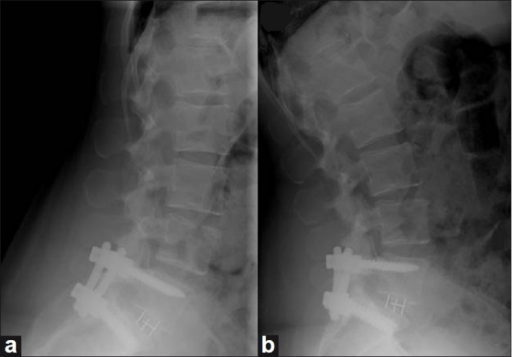 Lateral flexion (a) and extension (b) radiographs of th | Open-i