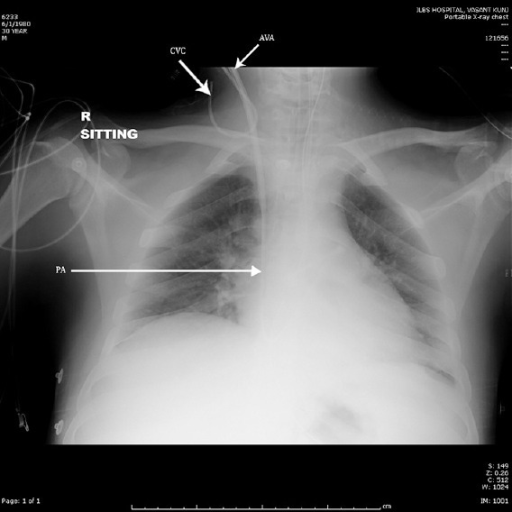 Postoperative chest radiograph showing malpositioned ce | Open-i