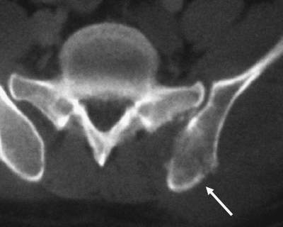 Case 2. Plain CT showed a lytic lesion in the posterior | Open-i