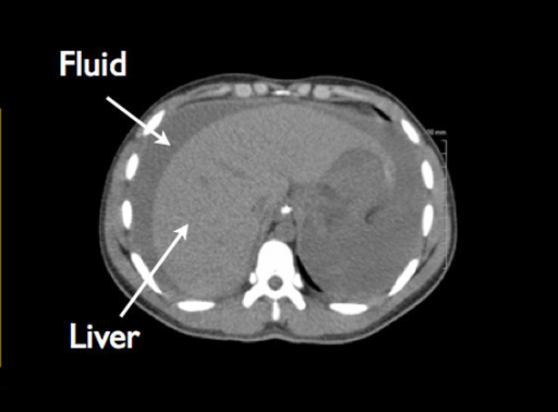 excess water in abdomen