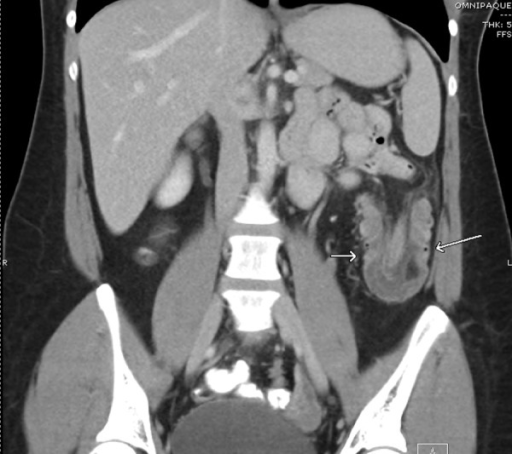 Coronal Abdominal CT of Intussuscepting Lipoma. | Open-i