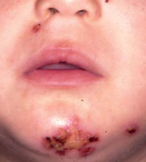 Crusted Impetigo Vesicles Honey Colored And Hematic Open I   PMC4008061 Abd 89 02 0293 G04 