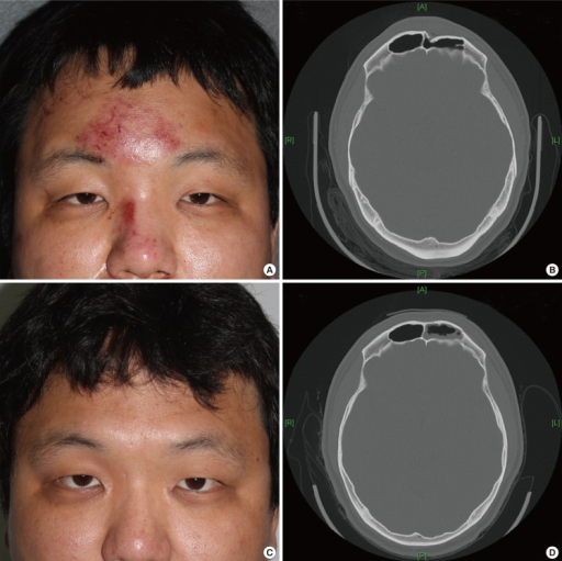 forehead skull fracture