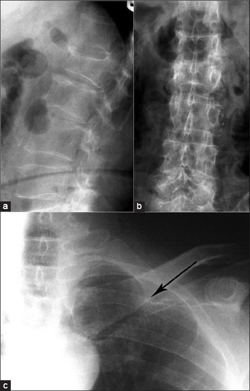 X-ray lumbosacral spine lateral view (a) and anteropost | Open-i