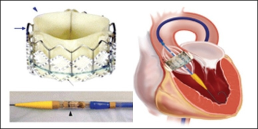 Edwards-Sapien percutaneous heart valves. Bovine perica ...