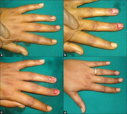 (a) Nail Bed Injury With Subungual Hematoma.(b) Nail Be | Open-i