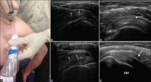 Subacromial impingement. (A) Probe placement for inject | Open-i