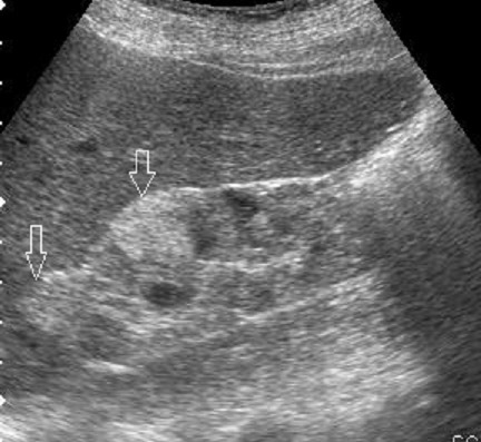 Ultrasound image shows renal cysts and angiomyolipomas | Open-i