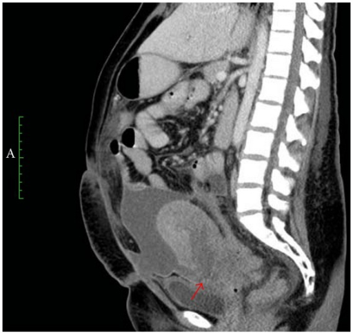 This Sagittal Ct Of The Abdomen Better Demonstrates The Open I