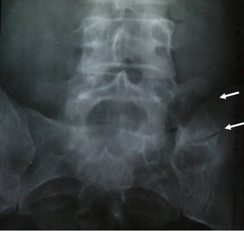 fifth lumbar vertebra