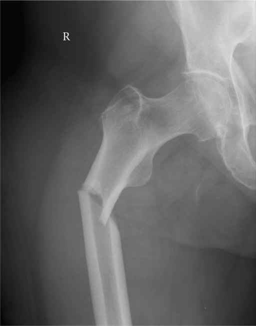 Subtrochanteric fracture in the same patient as Figures | Open-i