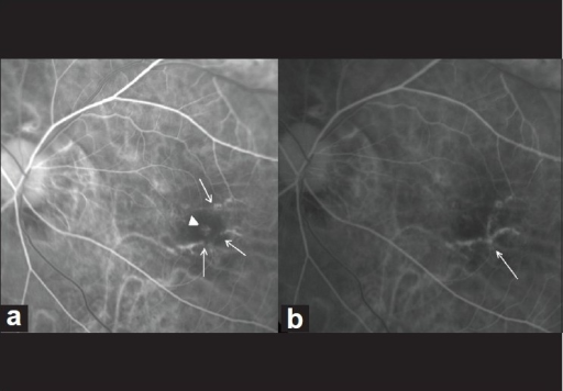 A Pretreatment Fluorescein Angiography Arteriovenous Phase Showing Classic Choroidal Neovascularization Arrow A Pretreatment Fluorescein Angiography Arteriovenous Phase Showing Classic Choroidal Neovascularization Arrow