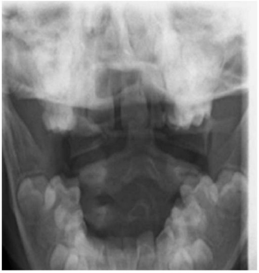 Open-mouth X-ray of the odontoid peg suggesting transve | Open-i