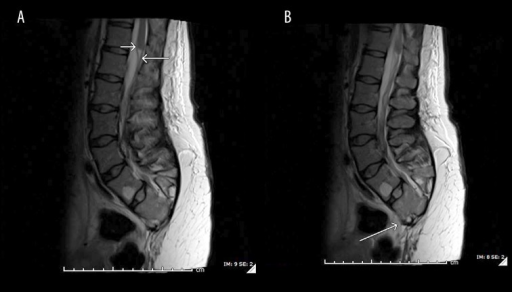 T2weighted Sagittal Mri Showing Spinal Cord Conus