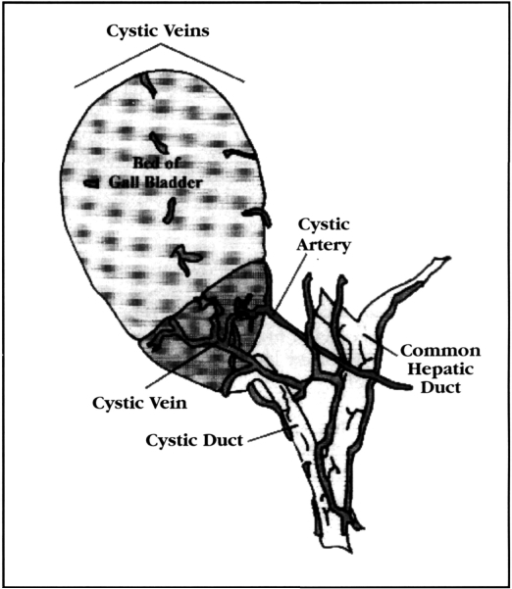 Cystic Veins within the Triangle of Calot (posterior vi | Open-i