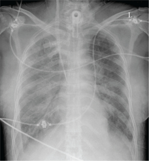 The chest X-ray on ICU admission reveals pulmonary edem | Open-i