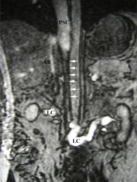 Coronal gradient echo MRI showing atresia of IVC betwee | Open-i