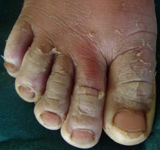 right-foot-of-6-years-old-girl-with-peeling-of-the-feet-open-i