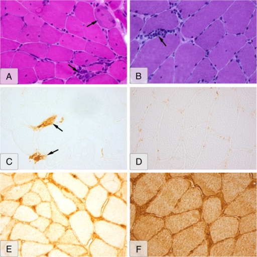 Histopathologic muscle-biopsy images of SSc-PM overlap patient versus PM patient. Left side (A, C, E): SSc-overlap patient. Right side (B, D, F): PM patient. (A) Hematoxylin & eosin (H&E) stain; upper marker, necrosis; lower marker, lymphocytic infiltrate; (B) H&E stain; marker, lymphocytic infiltrate; (C) MAC stain; markers, MAC upregulation; (D) MAC stain, no upregulation; (b v 02D7; (E) MHC class I stain, sarcolemmal MHC class I upregulation; (F) MHC class I stain, sarcolemmal and diffuse cytoplasmic MHC class I upregulation.