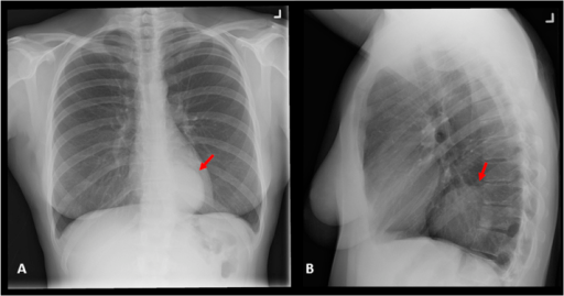 Chest X-ray. (A) Posteroanterior and (B) lateral views | Open-i