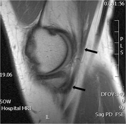 MRI of knee showing a normal semimembranosus tendon (ar | Open-i