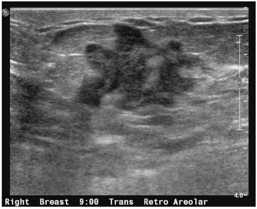 Focused ultrasound of the right breast in the retroareo Openi Focused ultrasound of the right breast in the retroareo Openi
