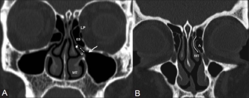 (A) Coronal CT scan shows the osteomeatal complex which comprises of ...