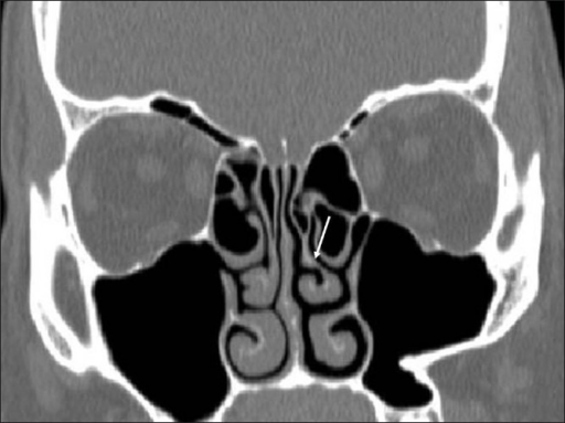 Coronal CT showing paradoxical left middle turbinate (a | Open-i