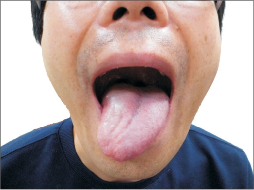 tongue-deviates-to-the-right-side-on-protrusion-and-it-open-i