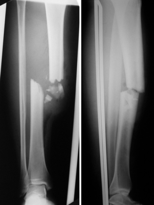 comminuted tib fib fracture nondisplaced