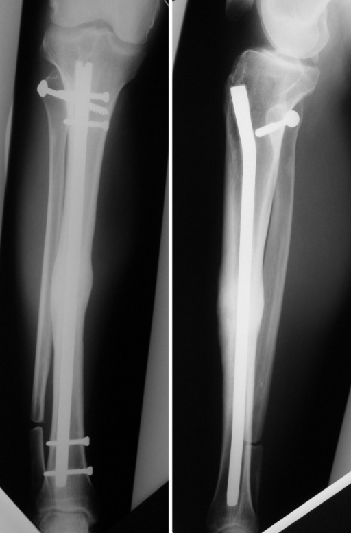 Tibial nail | Radiology Case | Radiopaedia.org