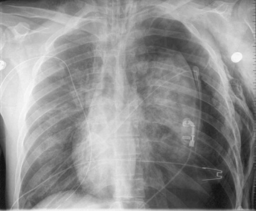 Chest film revealing persisting tension pneumothorax on | Open-i