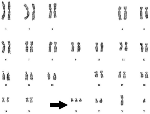 Trisomy 21 classical karyotype | Open-i