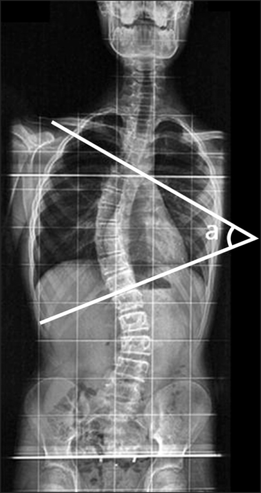 X Ray Cobb Angle At Lena Bates Blog