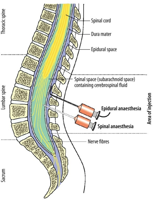 Differences between epidural and spinal anesthesia. In Openi