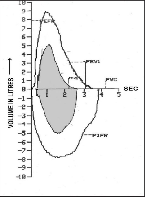 Representative flow volume loop showing gross derangeme | Open-i