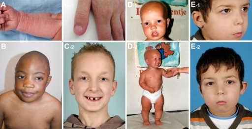 Dysmorphic features in other syndromic PID a Wiskott 