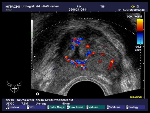 Colour Doppler Transrectal Ultrasound Transverse Image Open I 1148