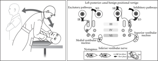 Posterior canal BPPV in a left ear showing Dix Hallpike | Open-i