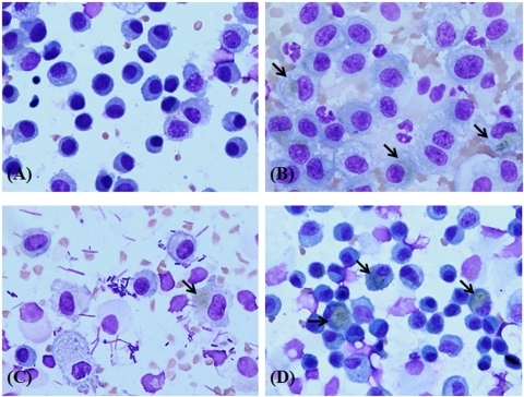 Images of cells in bronchoalveolar lavage (BAL) fluid f | Open-i