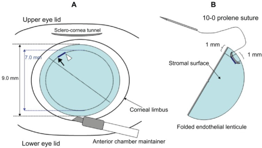 Schematic diagram for the use of a 10-0 prolene suture | Open-i