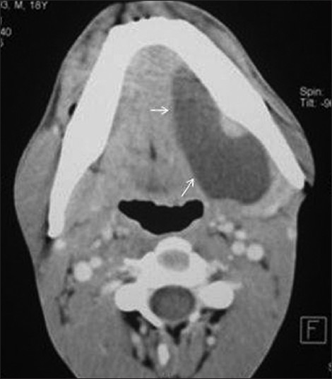 Plunging ranula: Axial contrast-enhanced CT scan shows | Open-i